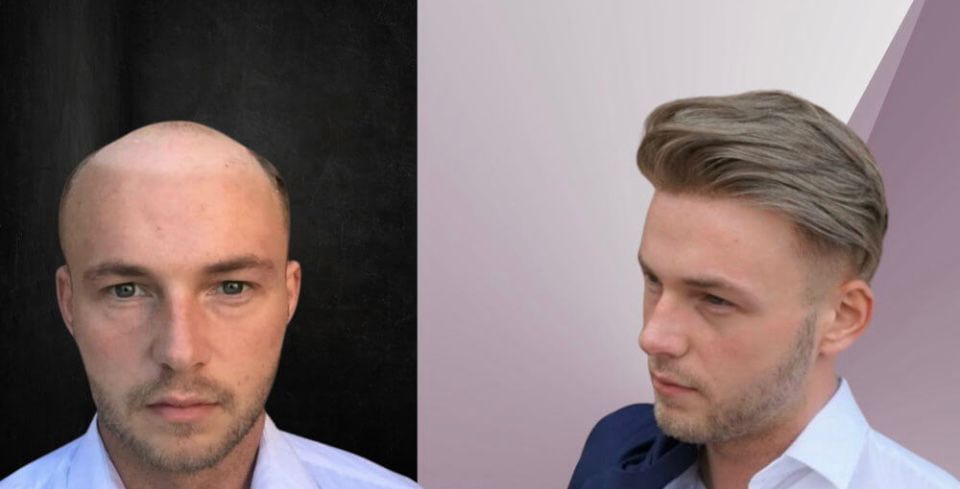 Men’s Hair Systems London: Non-Surgical Hair Replacement at Hector’s Global Hair with Zeal – image 2