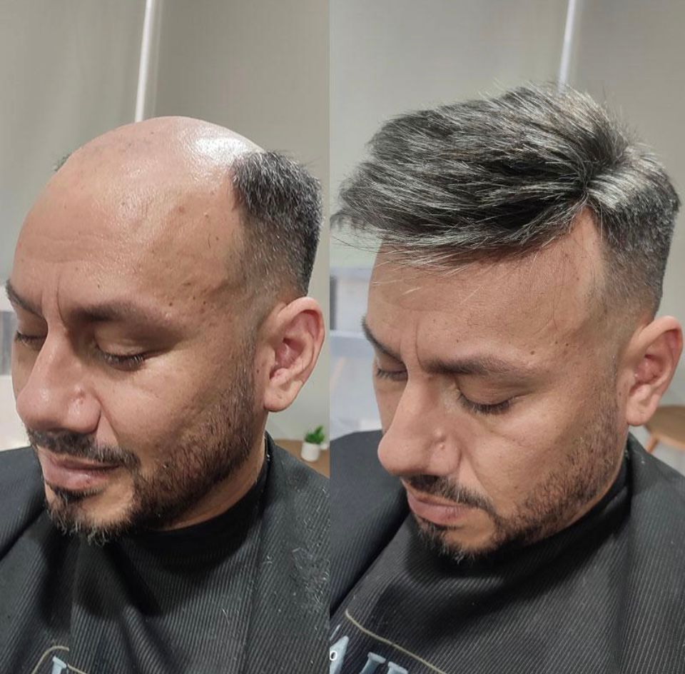Men’s Hair Systems London: Non-Surgical Hair Replacement at Hector’s Global Hair with Zeal – image 4